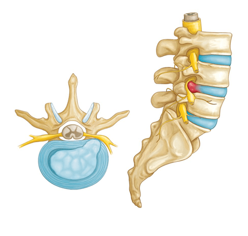 dolor de espalda debido a una hernia intervertebral