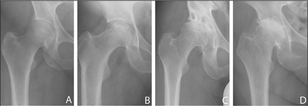 Etapas de desarrollo de la artrosis de la articulación de la cadera en una radiografía. 