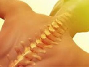 Osteocondrosis - Enfermedad de la columna