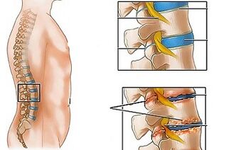 Las causas de la osteocondrosis de la lumbar