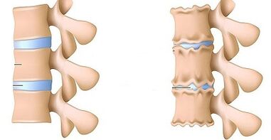cómo reconocer la presencia de osteocondrosis de la lumbar