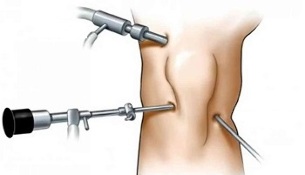artroscopia para la artrosis de la articulación de la rodilla