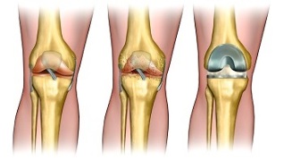 endoprótesis para la artrosis de la articulación de la rodilla
